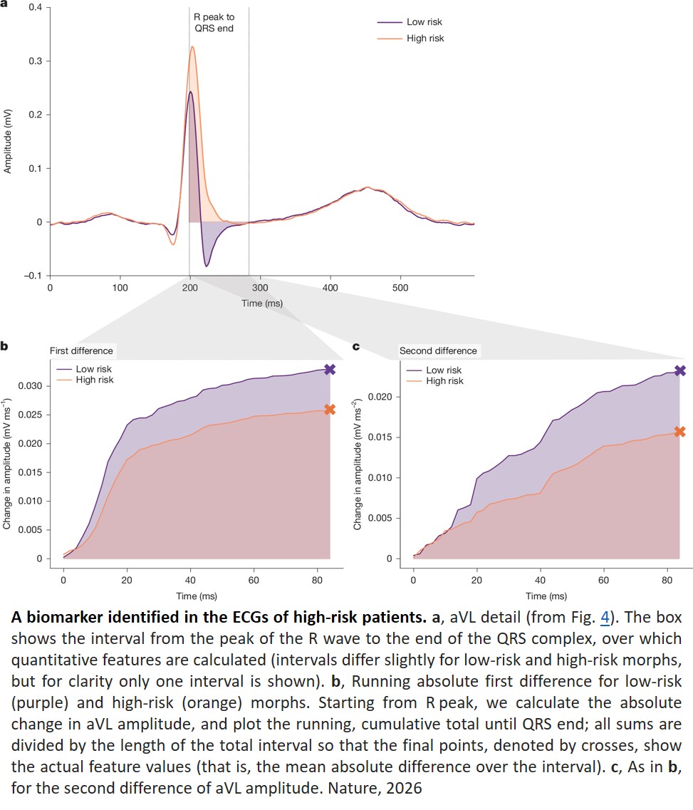 AI discovers sudden cardiac death ECG biomarker