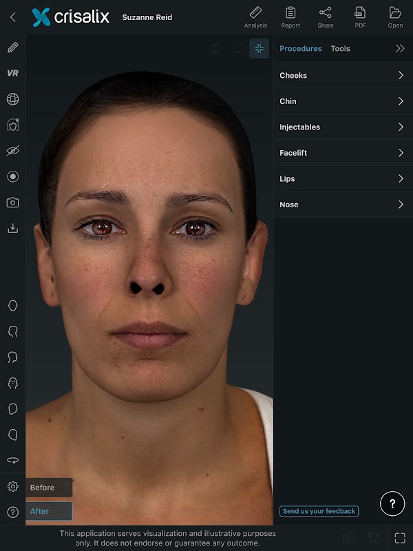 Simulation 3D des visages dans l’application Crisalix.
