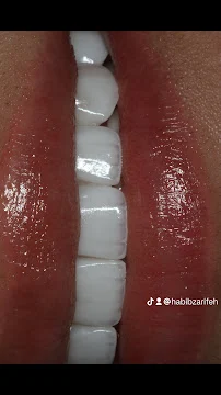 Ferrari Dental Clinic Lebanon Hollywood smile before after — Dr. Habib Zarifeh 2026