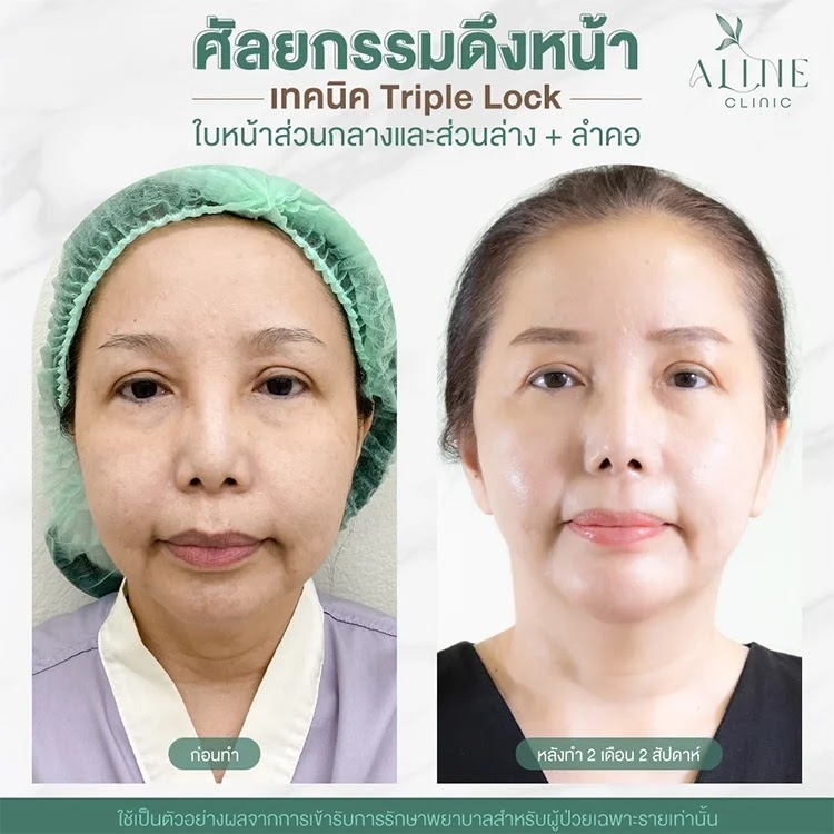 รีวิวผ่าตัดดึงหน้า ALINE Clinic