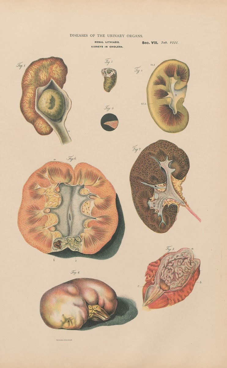 Renal Lithiasis Kidneys In Cholera 1888