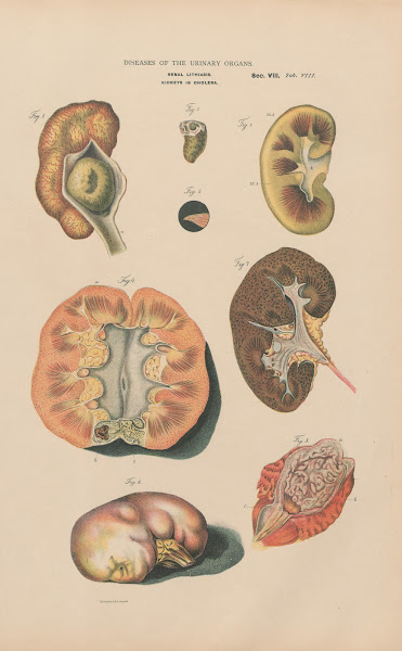 Renal Lithiasis Kidneys In Cholera 1888