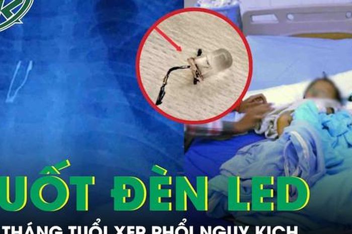Kinh hoàng: Bé 9 tháng tuổi xẹp phổi vì nuốt bóng đèn LED - Báo Sức Khỏe &amp; Đời Sống