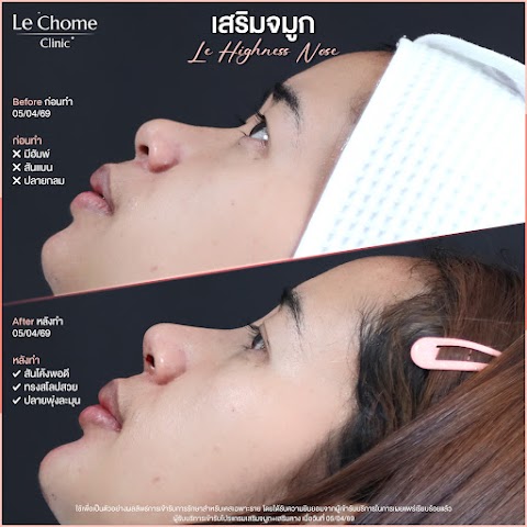 เสริมจมูก