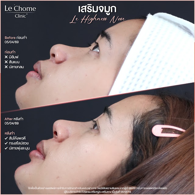 รีวิวเสริมจมูก — เสริมจมูก