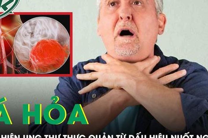 Người đàn ông tá hỏa phát hiện mắc ung thư thực quản từ dấu hiệu nuốt nghẹn - Báo Sức Khỏe &amp; Đời Sống