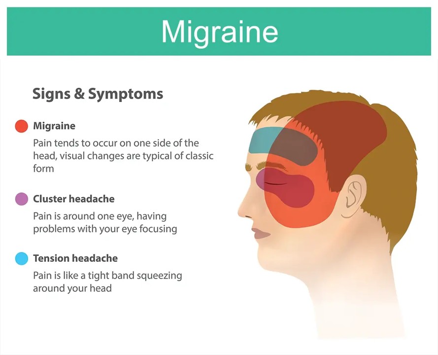 Migraine