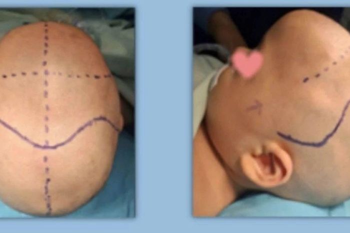 Tạo hình hộp sọ cho bé 10 tháng tuổi bị biến dạng hộp sọ - Báo Tri thức &amp; Cuộc sống