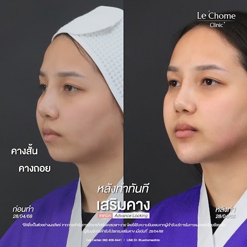 เสริมคาง (ใหม่)