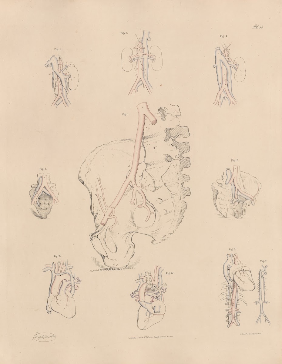 Unusual conformation of the Iliac arteries 1844
