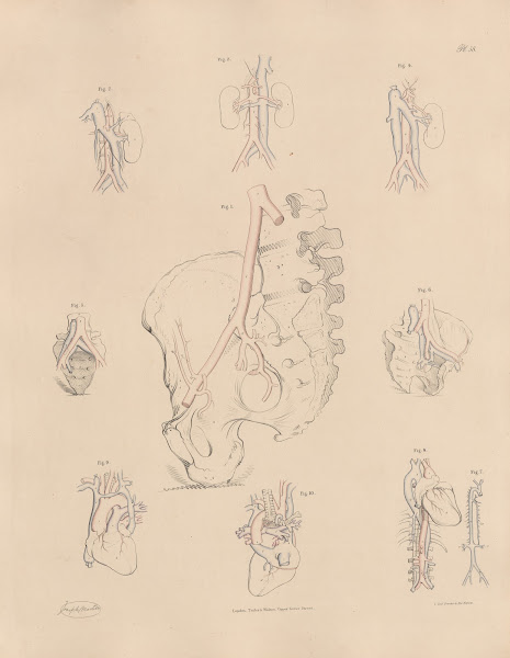 Unusual conformation of the Iliac arteries 1844