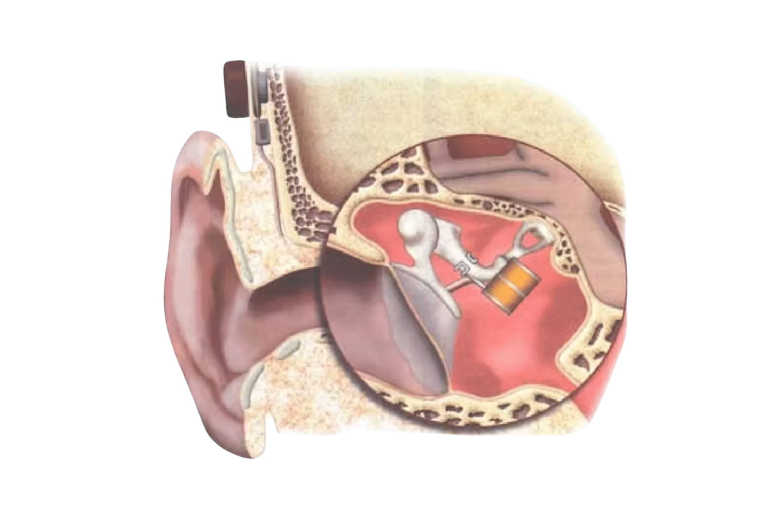Limites des implants de l'oreille moyenne