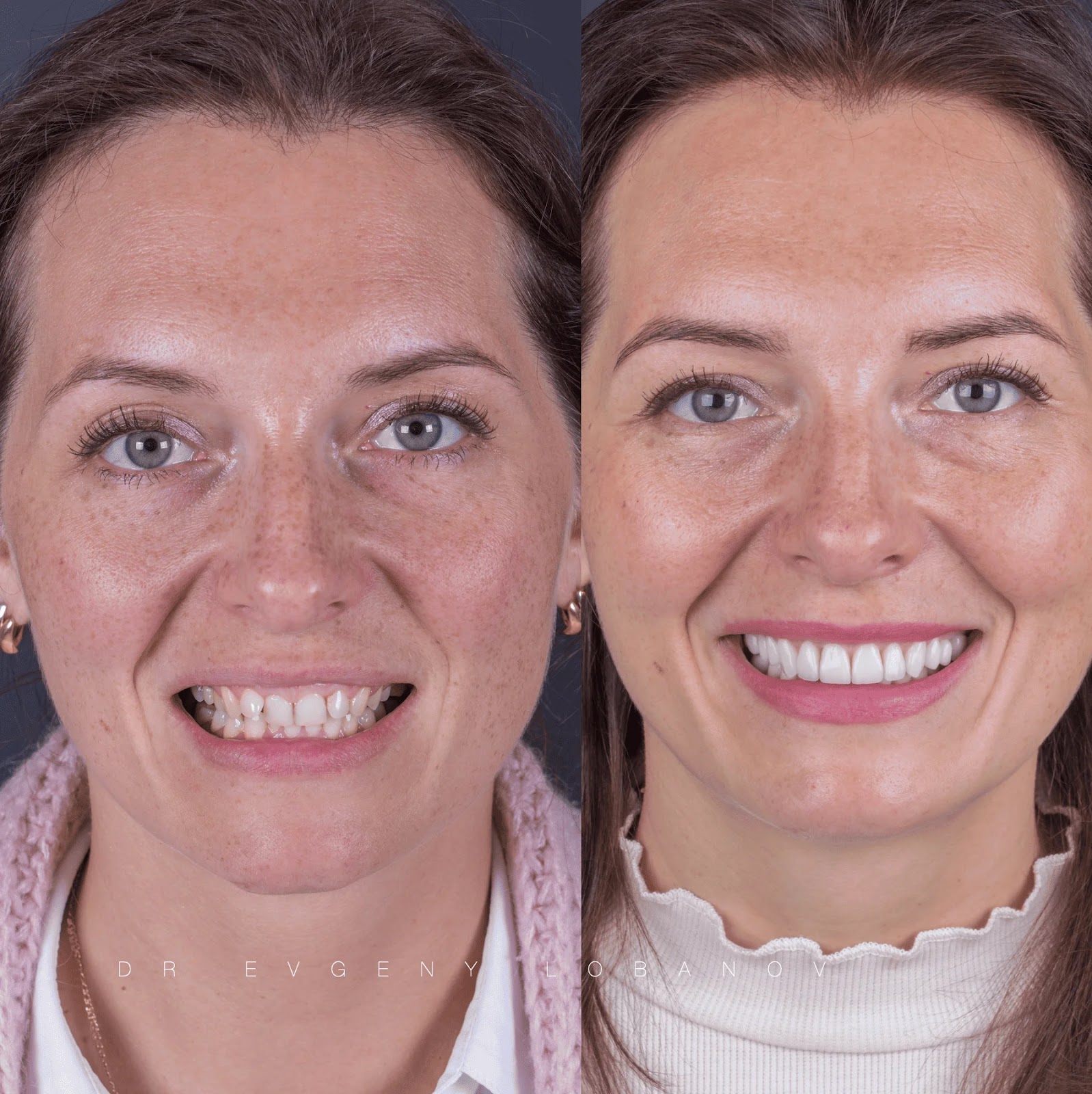 До и после установки керамических виниров