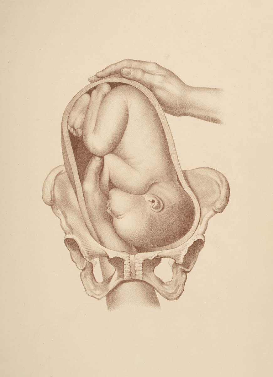 Artificial LaborVersion in First Position of the Vertex Left Occipito iliac 1885