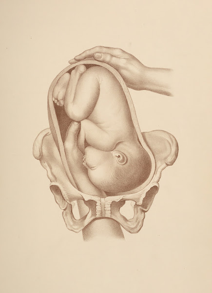 Artificial LaborVersion in First Position of the Vertex Left Occipito iliac 1885