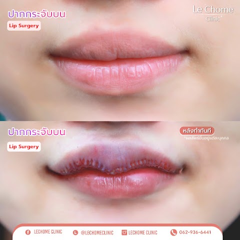 ตกแต่งริมฝีปาก