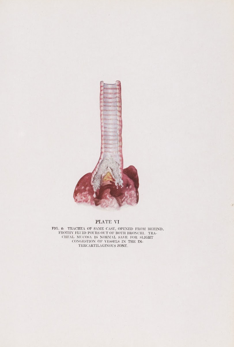 Plate VI Fig 2 Trachea of same case opened from behind 1920