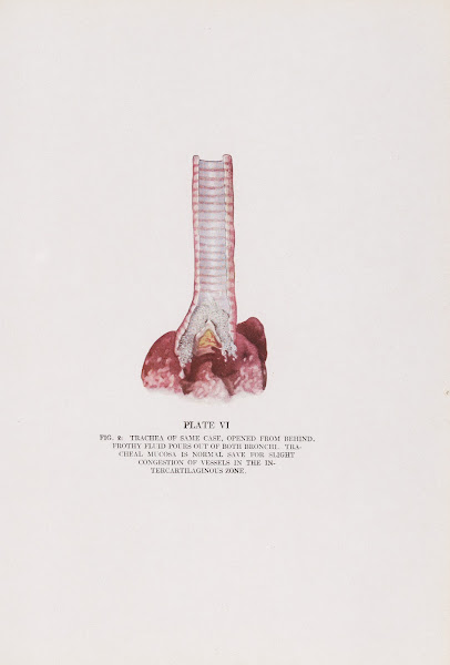 Plate VI Fig 2 Trachea of same case opened from behind 1920