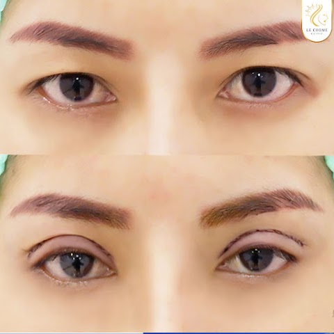 ตา 2 ชั้น