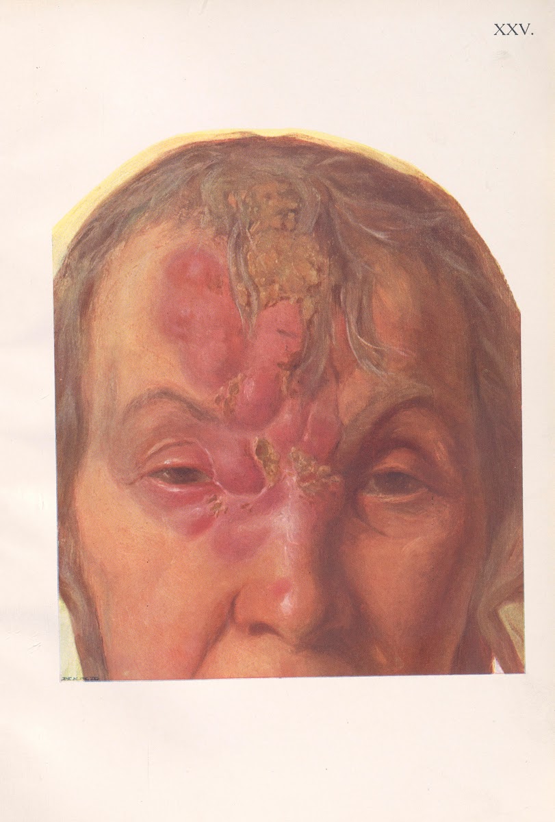 Venereal diseases  Syphilis Pl25 1908