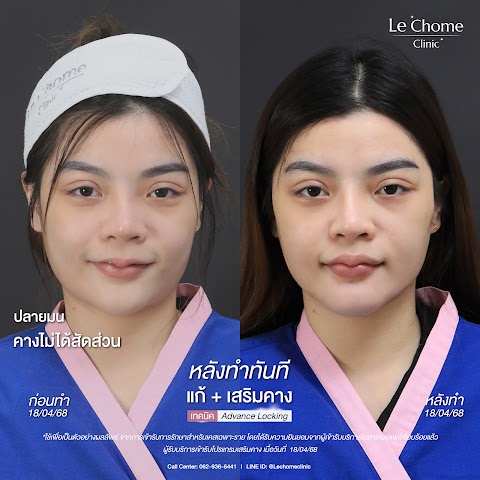 รีวิวเสริมคาง — แก้ซิลิโคน+เสริมคาง