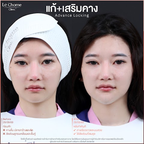 รีวิวเสริมคาง — แก้ซิลิโคน+เสริมคาง