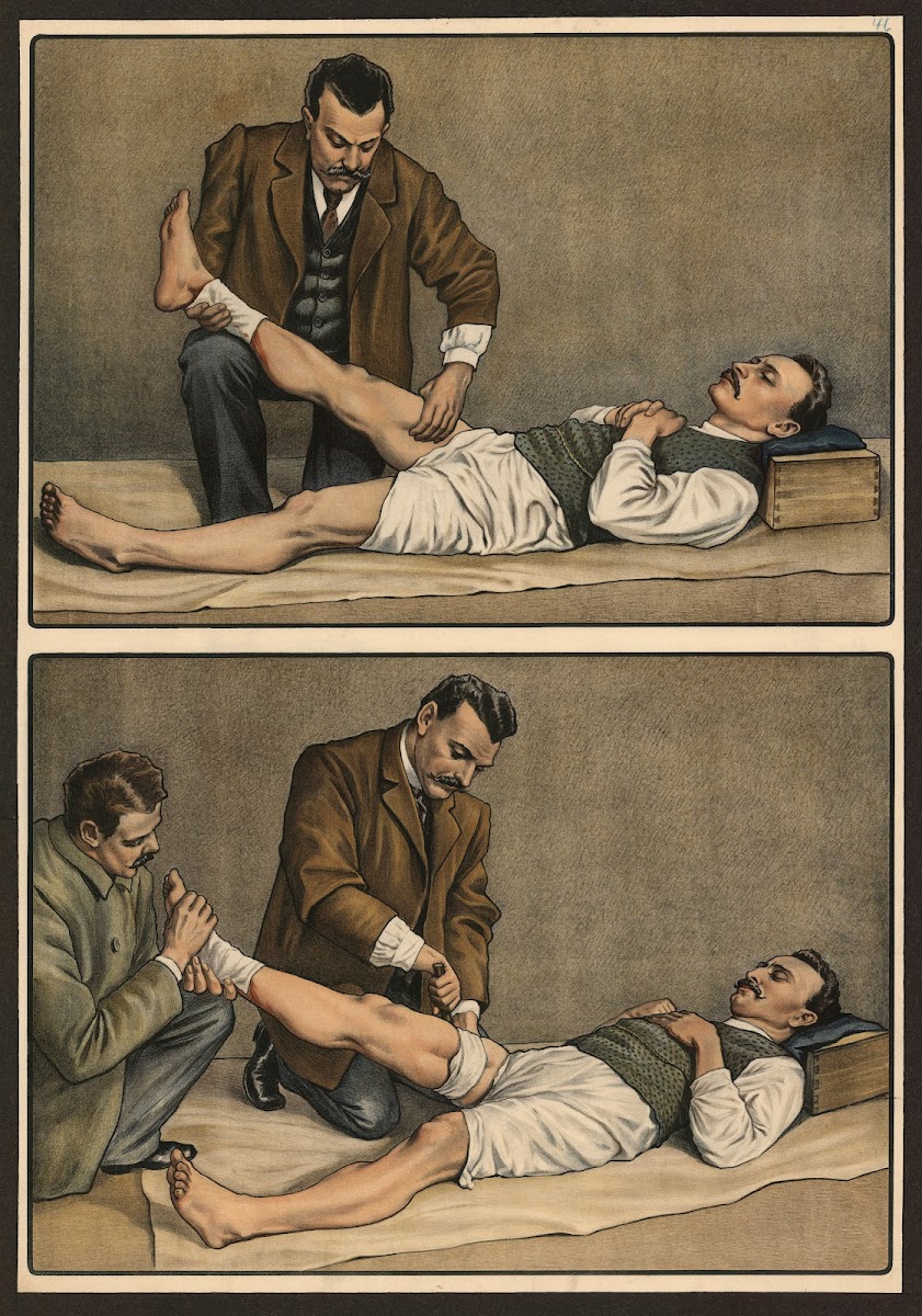 Broken bones 1911