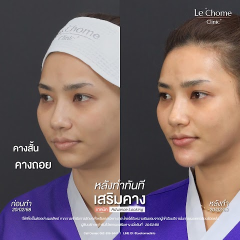 เสริมคาง (ใหม่)