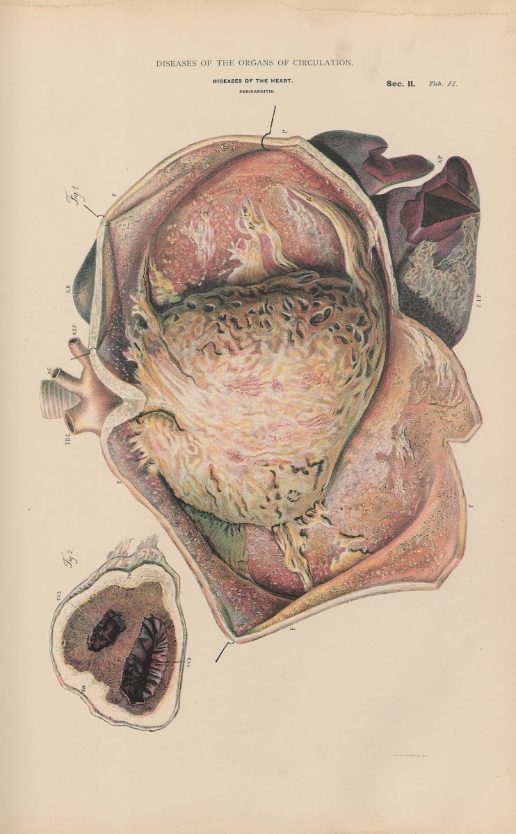 Hydro Pericarditis 1888