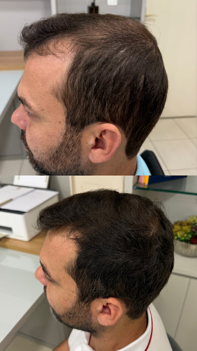 Antes e depois linha frontal capilar
