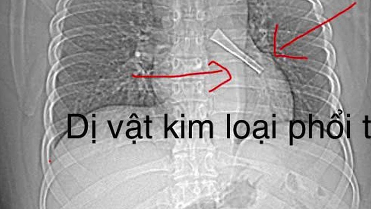 Ho không dứt, bác sĩ phát hiện cán thìa inox mắc trong phế quản bệnh nhân - Báo Sức Khỏe &amp; Đời Sống