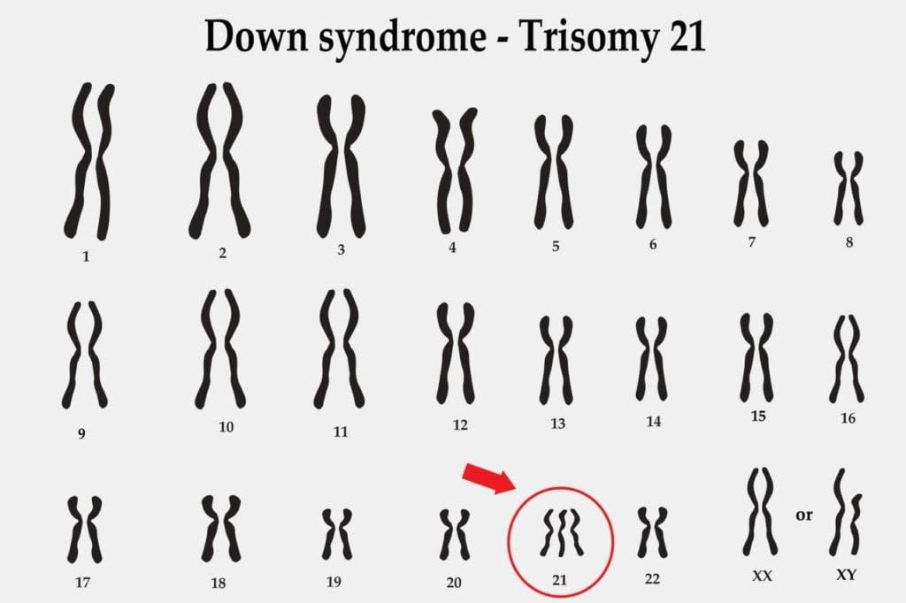 Trisomy