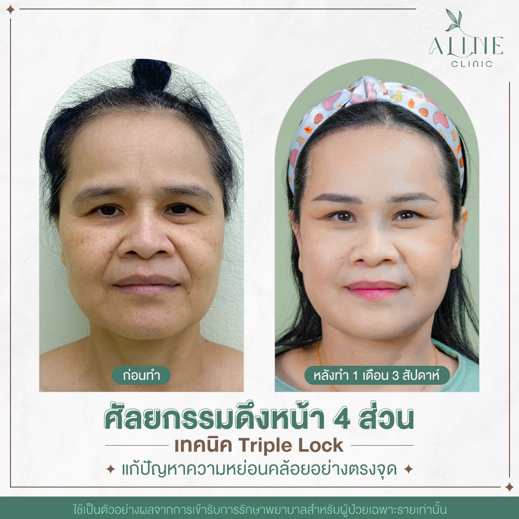 รีวิวผ่าตัดดึงหน้า ALINE Clinic