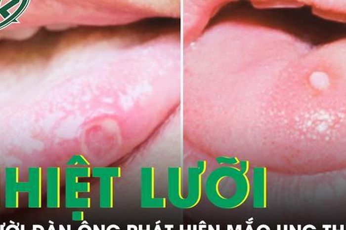 Người đàn ông phát hiện mắc ung thư từ dấu hiệu lạ ở lưỡi - Báo Sức Khỏe &amp; Đời Sống