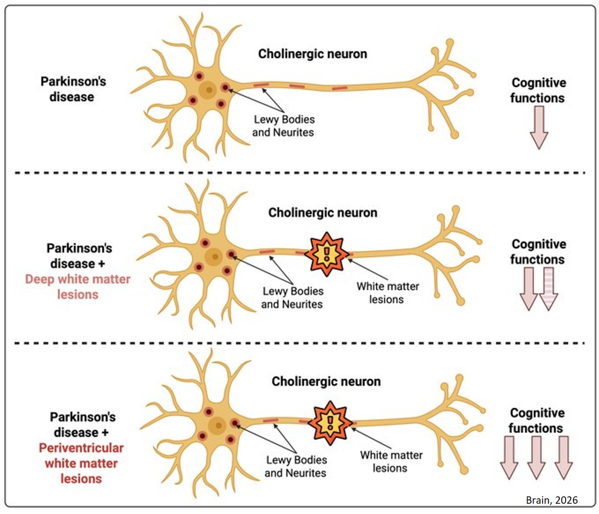 White matter lesions disrupt cholinergic pathways important for cognition in Parkinson’s disease