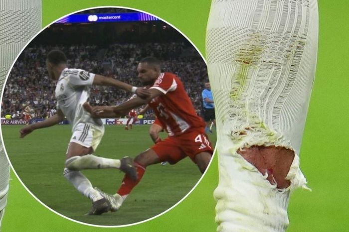 Vết thương gây lo lắng của Mbappe - Tạp chí Tri thức