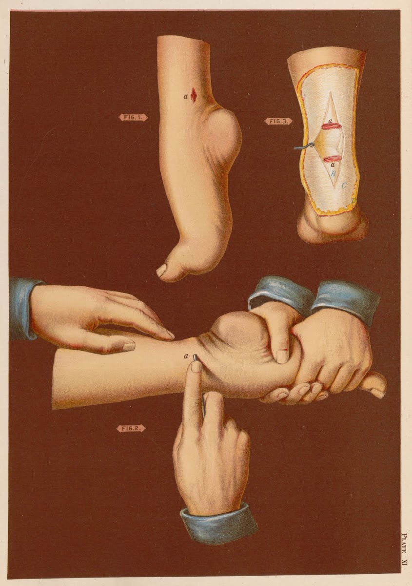 Section of tendo achilles talipes equinus 1889