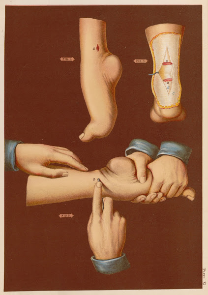 Section of tendo achilles talipes equinus 1889