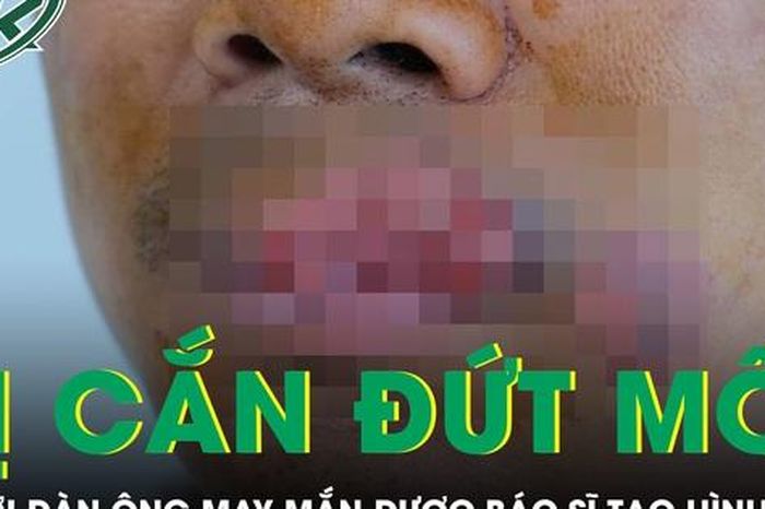 Người đàn ông bị cắn mất môi phải trải qua ca tạo hình phức tạp - Báo Sức Khỏe &amp; Đời Sống
