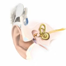 Avantages de l'implant cochléaire