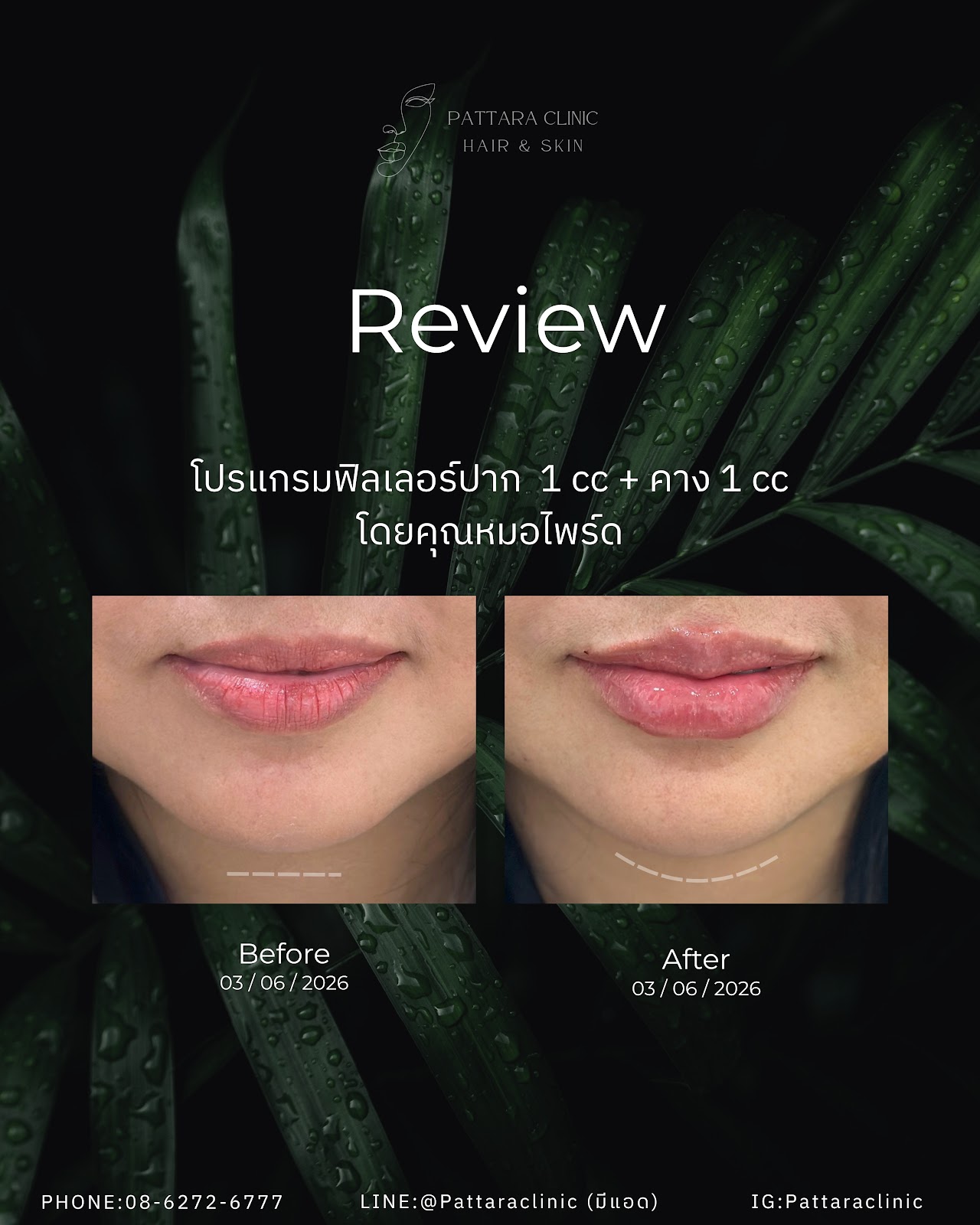 รีวิวฟิลเลอร์ปากและคาง