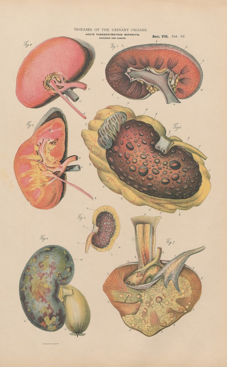 Acute Parenchymatous Nephritis 1888