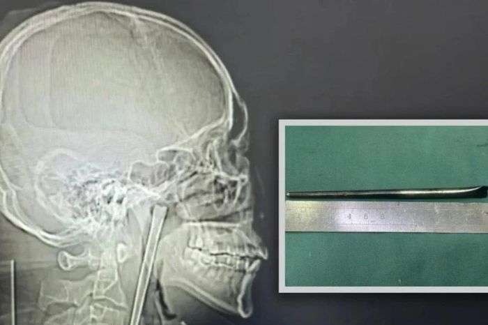 Chuyện hy hữu, 8 năm sống chung với chiếc đũa trong cổ họng - Báo Tri thức &amp; Cuộc sống