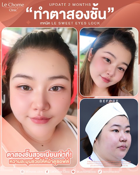 ตา 2 ชั้น