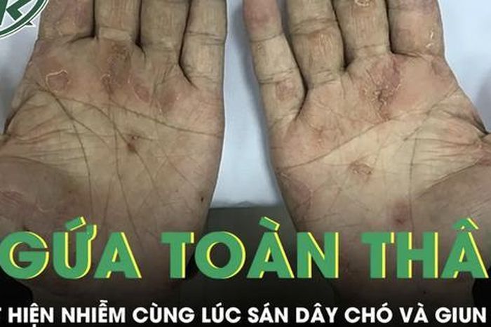Ngứa toàn thân suốt 2 tháng, người đàn ông phát hiện nhiễm cùng lúc sán dây chó và giun đũa - Báo Sức Khỏe &amp; Đời Sống