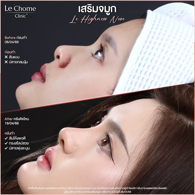 รีวิวเสริมจมูก — เสริมจมูก