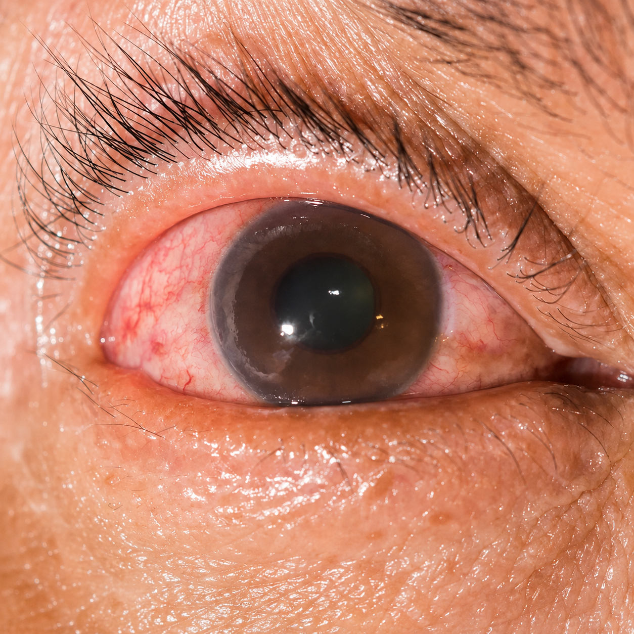 Fundus photograph showing a branch retinal vein occlusion