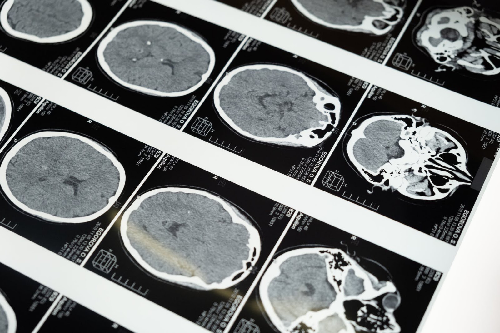 IIT Madras to Map 100 Human Brains at Cellular Scale