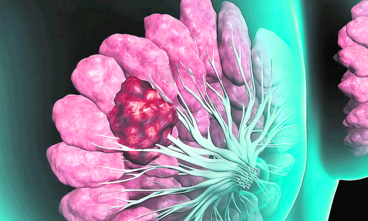 Estrategias de Dinamarca para el cáncer: un modelo de gestión hospitalaria eficiente y centrado en el paciente