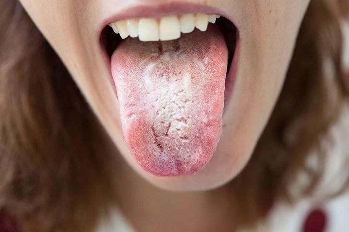 Nấm miệng họng do Candida: Đừng chủ quan với mảng trắng bất thường - Báo Tri thức &amp; Cuộc sống